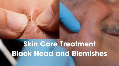 blackhead squeeze youtube