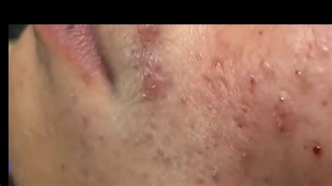 Blackheads Pimples Part 3