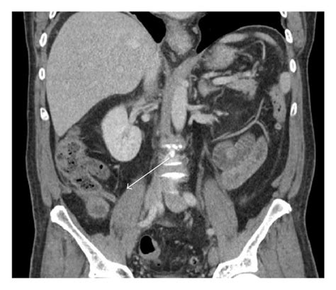 bladder decompressed on ct