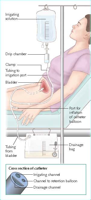 Bladder Irrigation Solution Normal Saline