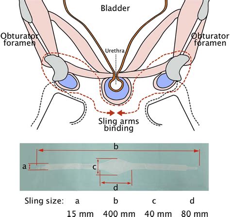 bladder sling for male incontinence