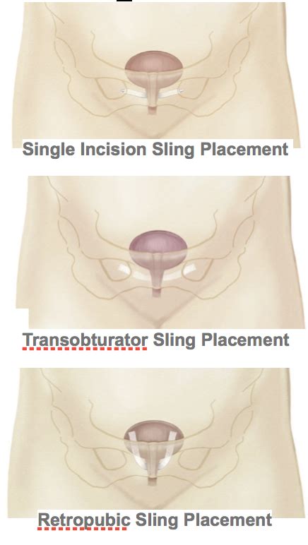 Understanding the Bladder Sling Procedure for Stress Incontinence Relief