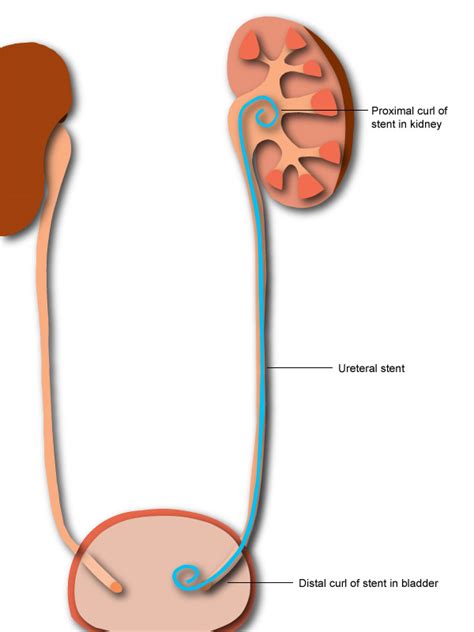 What to Expect During Bladder Stent Removal Procedure