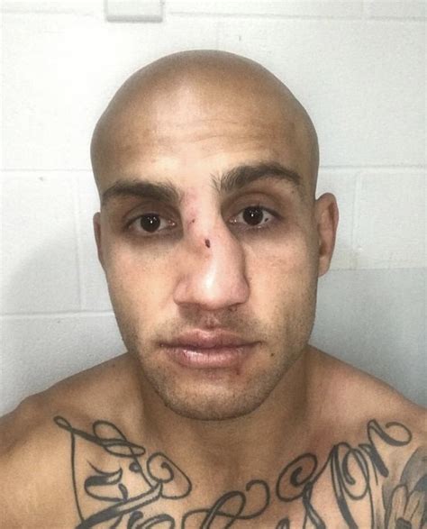 blake ferguson broken nose