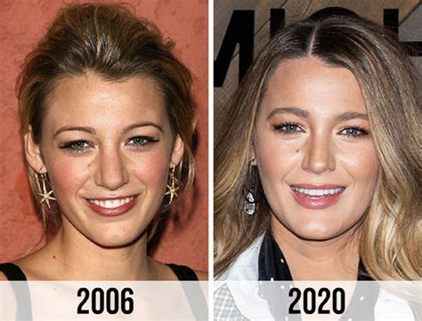 blake lively nose