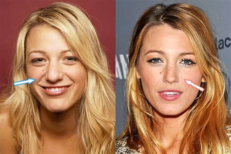 Blake Lively's Plastic Surgery: Unveiling the Secrets Behind the Star's Look