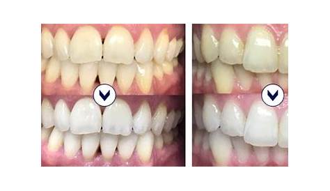 Blanchiment Gouttiere Avant Apres Dentaire WHITECARE Consultez Les Photos