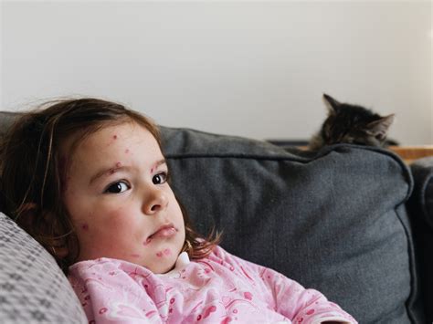 Blankets With Measles