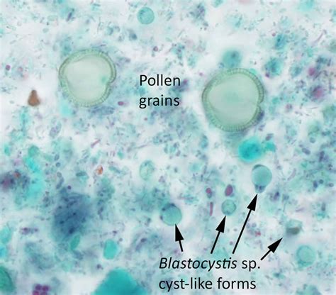 blastocystis hominis infection