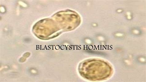 blastocystis hominis quiste