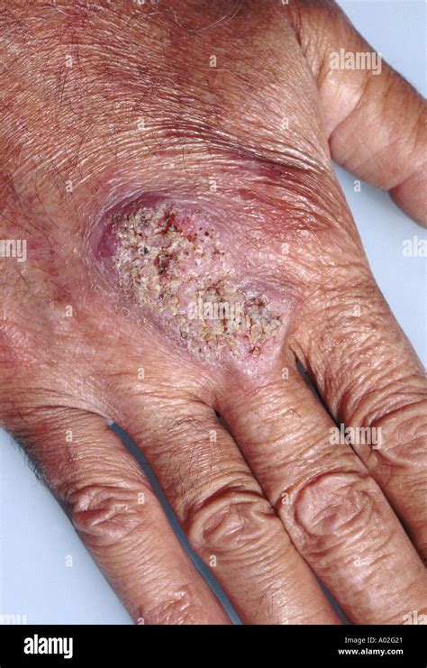 blastomycosis skin lesions