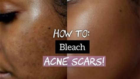 Bleach On Acne