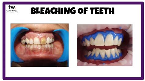 Bleached Definition Medical