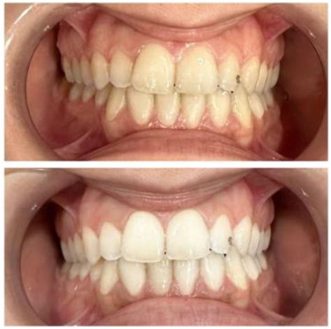 Bleaching Teeth With Hydrogen Peroxide