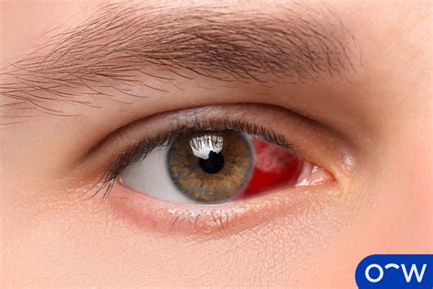 What Causes Bleed on Eye White: Understanding the Symptoms and Treatment Options