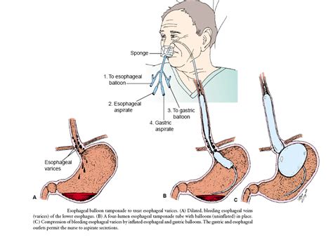 bleeding esophageal varices treatment