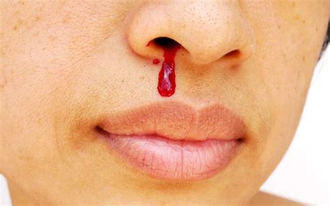 Why Do I Keep Getting a Bleeding Nose Randomly: Causes and Solutions