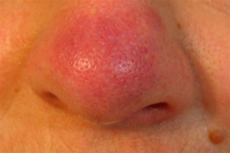 bleeding pore on nose