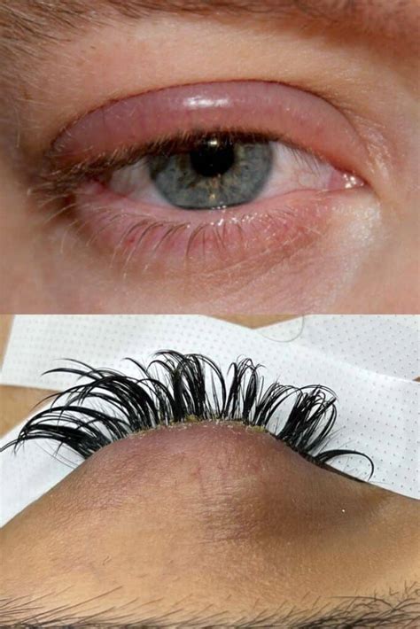 blepharitis and eyelash extensions