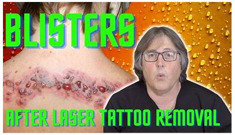 Blister After Tattoo Removal Abschaffen Fernsehgerät Acht Lasern Picosure 100 Jahre Mangel