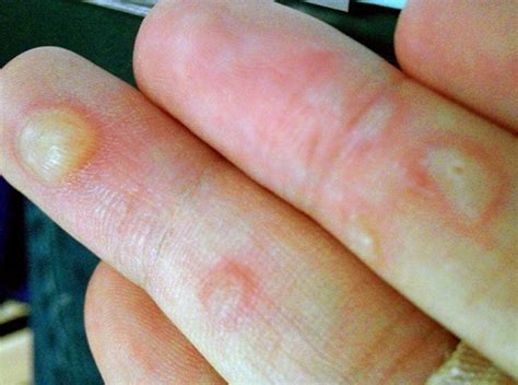 What Causes a Blister on Hand and How to Treat?