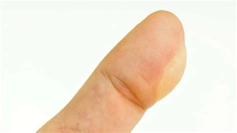 Blister On Thumb From Golf (Remedies, Prevention)