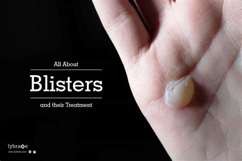 blisters meaning in tamil