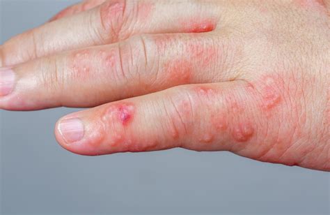 blisters on arms and hands from shingles