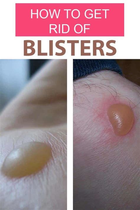 blisters on arms and hands home remedies