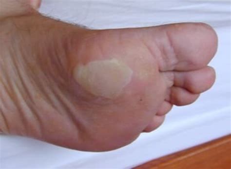 blisters on bottom of feet