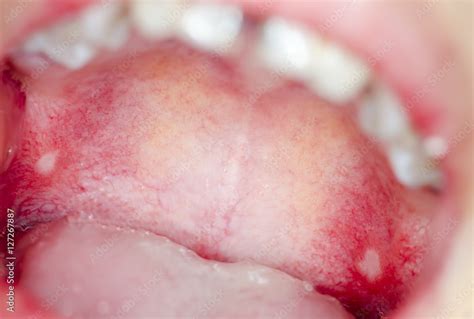 blisters on roof of mouth