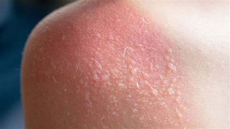 blisters on skin after sunburn