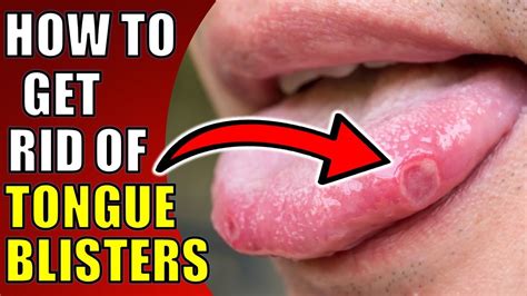 blisters on tongue
