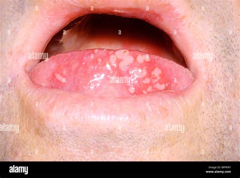 blisters on tongue virus