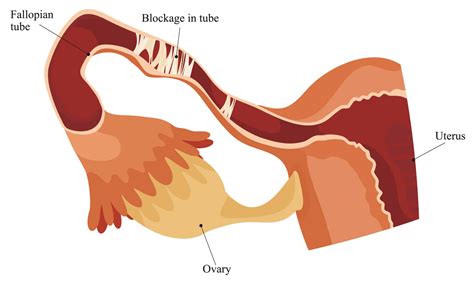 Can a Blocked Fallopian Tube be Cleared Without Surgery?