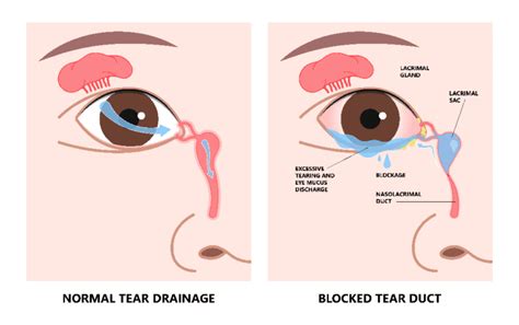 Unclogging Blocked Tear Ducts: Causes, Symptoms, and Effective Solutions