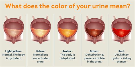 Hematuria or Blood in the Urine Causes, Symptoms