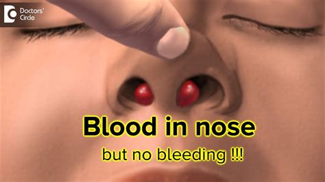 blood coming from nose