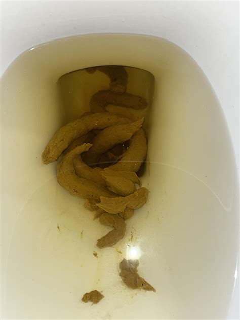 blood in stool colon cancer poop