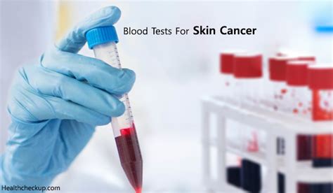 blood test for skin cancer