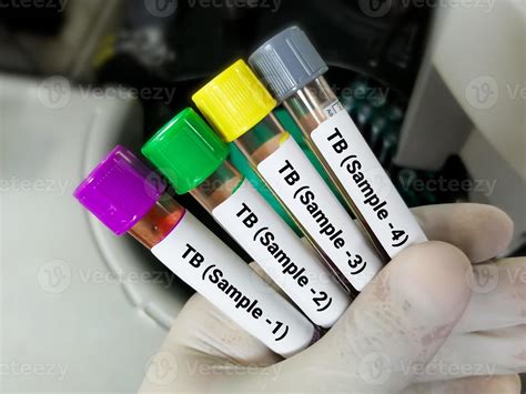 Blood Test For Tuberculosis