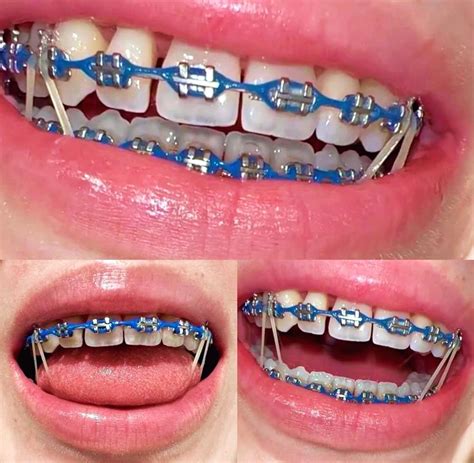 Blue Braces On
