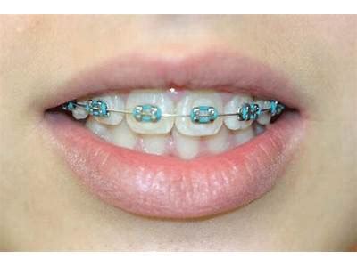Blue Braces Turned
