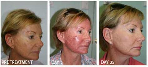 blue light therapy before and after photos