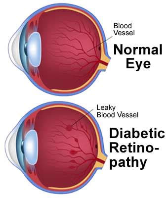 blurry vision diabetes type 1