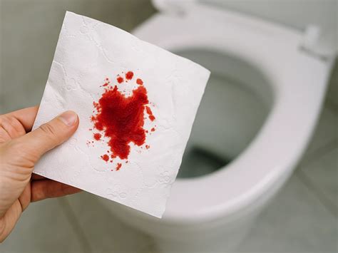 blut im stuhl