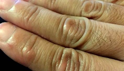 Top más de 60 imágenes sobre: alergia en las uñas delas manos - recién