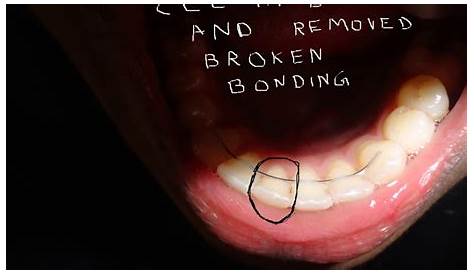 Broken bonded retainer advice Garstang Dental