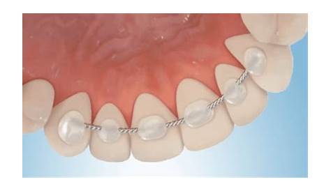 Bonded Retainer Top Teeth The Best Orthodontic For Your