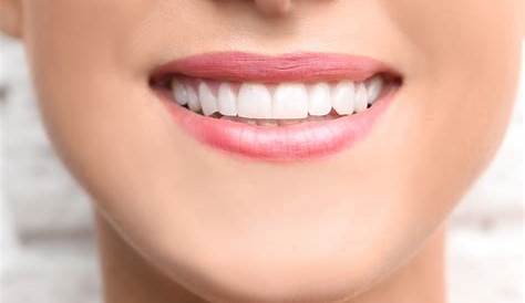 Bonded Teeth Bonding 101 Everything You Need To Know About The